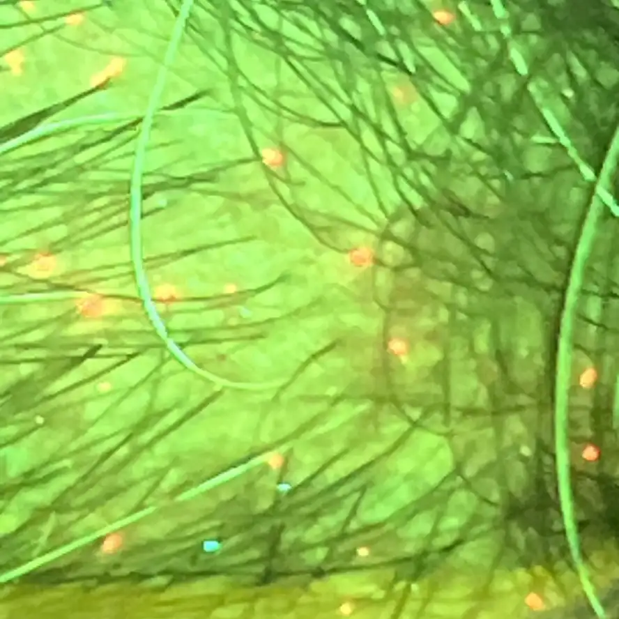 Mapeamento fluorescente do couro cabeludo — imagem 1